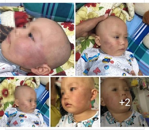 Vĩnh Long: Bé trai 19 tháng tuổi bị bảo mẫu tát vẫn phải điều trị tại bệnh viện