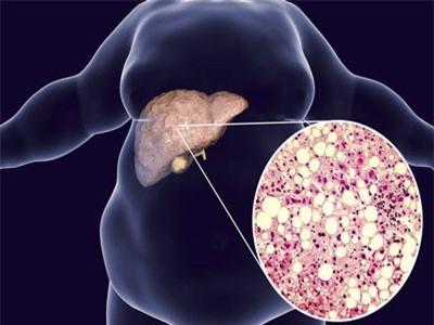 Ngăn ngừa nguy cơ mắc bệnh gan nhiễm mỡ bằng một số phương pháp đơn giản nhưng vô cùng hiệu quả