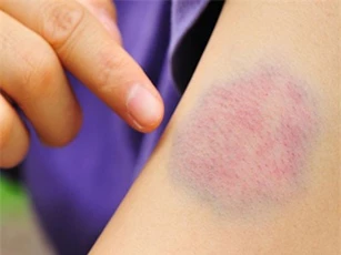 CLIP: Cảnh giác với các vết bầm tím trên da không rõ nguyên nhân