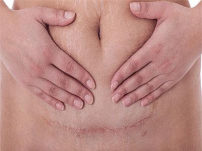 Đây chính là lộ trình giúp các mẹ sau sinh mổ phục hồi thật tốt và hiệu quả