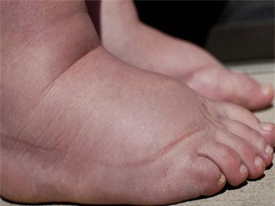 5 nguyên nhân không ngờ gây phù nề chân mà nhiều người không hề nghĩ đến