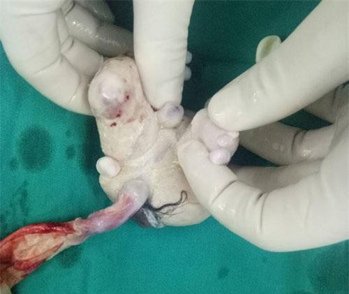 Bé trai 4 tháng tuổi… mang thai nặng 1,5kg