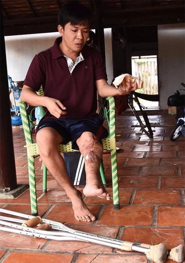 Anh Lê Thanh Thuận bị xe ben tông, thương tích 56%, chân ngắn đi 10cm, lái xe không bị xử lý hình sự (Ảnh T.L)