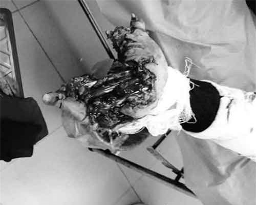 Nam thanh niên bị dập nát bàn tay vì điện thoại phát nổ