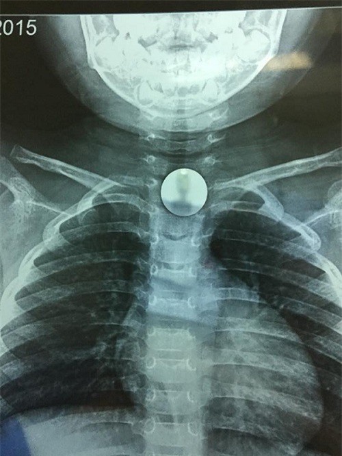 Hà Nội: Trẻ 3 tuổi bị hóc đồng xu do đùa nghịch