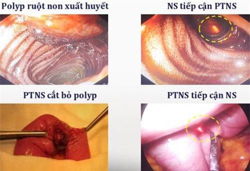 Huế: Bệnh nhân mất gần 3 lít máu đường tiêu hóa vì không tìm ra vị trí chảy máu