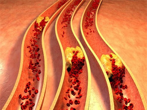Bài thuốc giảm cholesterol trong vòng 1 tháng