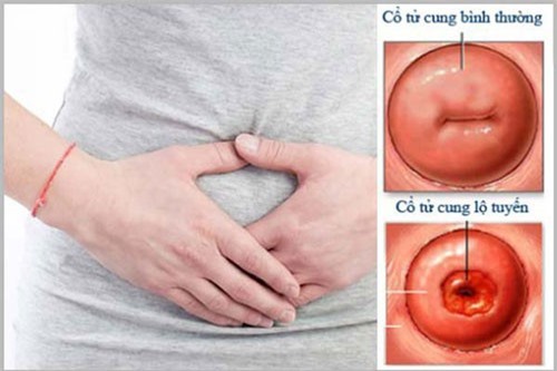 Những câu hỏi liên quan đến bệnh viêm lộ tuyến cổ tử cung