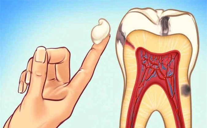 Vệ sinh răng bằng dầu: Bạn có thể ngăn chặn sự phát triển của sâu răng bằng cách loại bỏ những vi khuẩn gây hại với các loại dầu có tính kháng khuẩn như dầu dừa, dầu mè …