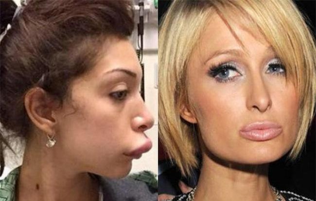 Khi mỹ nhân showbiz bơm môi: Phần lớn luôn biến thành thảm họa, có người còn như hóa trang vịt Donald!