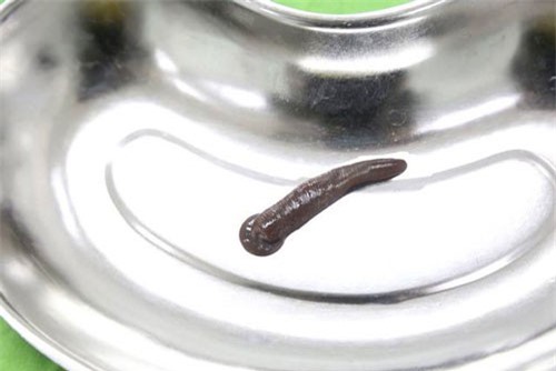 Kinh hoàng đỉa trâu sống ngoe nguẩy trong cổ họng bệnh nhân nhiều ngày