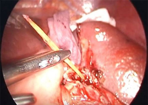 Bị đâm xuyên lách vì ngậm tăm đi ngủ