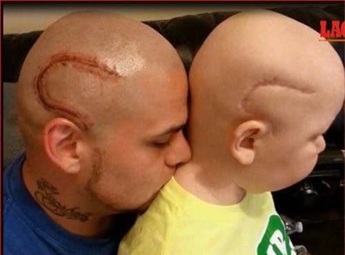 CLIP: Ông bố xăm hình giống vết sẹo để con không mặc cảm