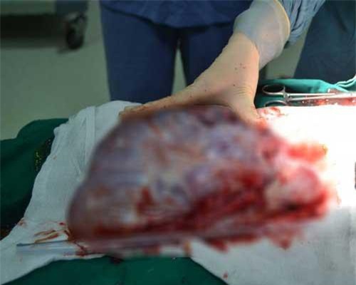 Cắt khối u buồng trứng nặng hơn... 6kg cho người phụ nữ 61 tuổi