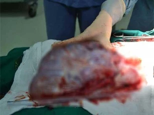 Cắt khối u buồng trứng nặng hơn... 6kg cho người phụ nữ 61 tuổi