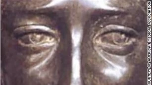 Một bức chạm khắc bằng đồng của nhân vật David, được cho là hình ảnh minh họa Leonardo da Vinci thời trẻ, cho thấy sự lệch trục mắt.