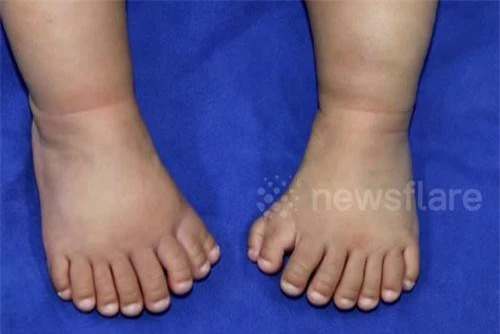 Đôi chân 15 ngón của cậu bé 'người rết'.