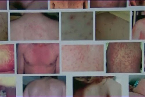 Dịch sởi có nguy cơ lan rộng