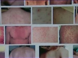 Dịch sởi có nguy cơ lan rộng