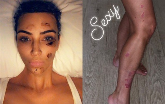 Kim Kardashian gây sửng sốt với đôi chân loang lổ và gương mặt bôi đầy thuốc vì bị bệnh vảy nến