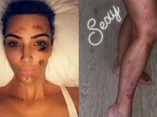 Kim Kardashian gây sửng sốt với đôi chân loang lổ và gương mặt bôi đầy thuốc vì bị bệnh vảy nến