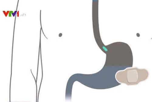 Viên thuốc kỹ thuật số nhắc bệnh nhân nhớ uống thuốc