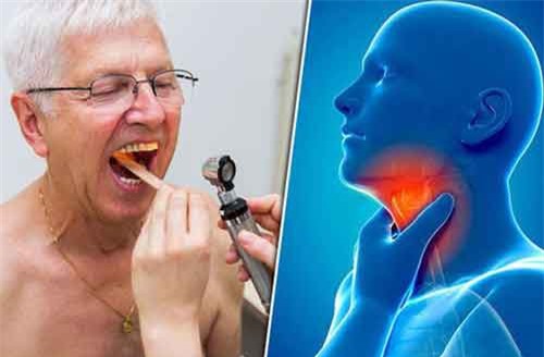 Đau họng kéo dài có thể là dấu hiệu ung thư