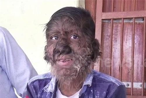 Clip: Cậu bé mang hình hài 'người Sói' suốt 13 năm