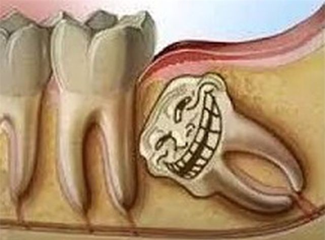 Răng khôn, vì sao phải nhổ bỏ?