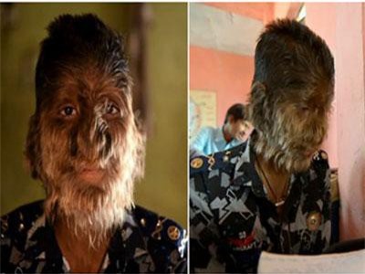 Cậu bé Ấn Độ và hội chứng 'người sói'