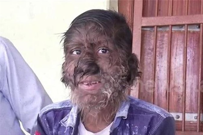 CLIP HOT (20/2): Cậu bé mang hình hài ‘người sói’, xe tải gây tai nạn rồi kéo lê ô tô 3km