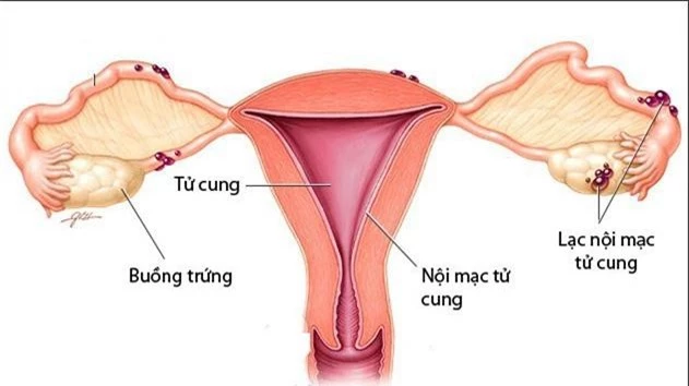 3 nguyên nhân phụ nữ dễ bị hiếm muộn - Ảnh 1.