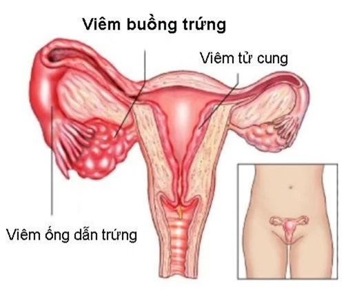 3 nguyên nhân phụ nữ dễ bị hiếm muộn - Ảnh 2.