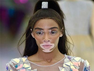 Siêu mẫu bạch biến nổi bật tại tuần lễ thời trang Milan