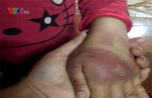 Bé gái 8 tuổi ở Thanh Hóa nghi bị bố đẻ bạo hành