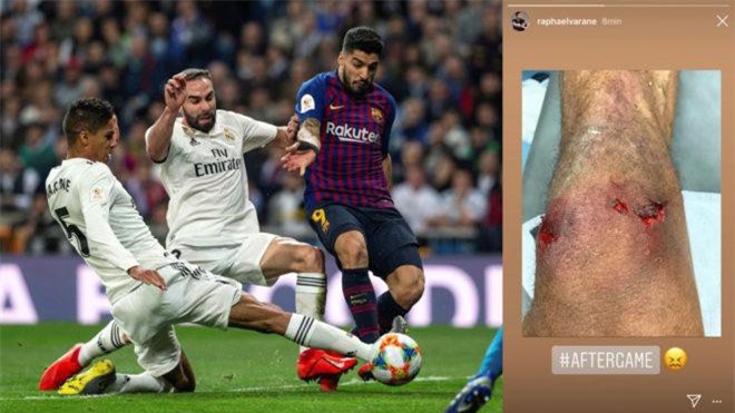 Varane khoe vết thương rợn tóc gáy