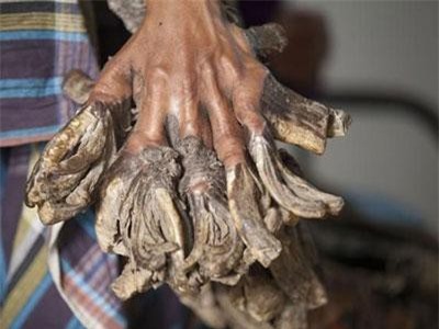 Căn bệnh bí ẩn mang tên 'người cây'