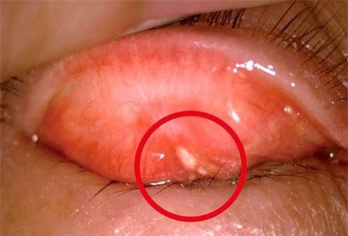 Cô gái Trung Quốc có sỏi trong mắt chỉ vì sở thích mà hội con gái thường làm mỗi ngày