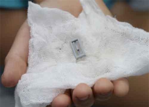 Bé 8 tuổi tím tái vì đồ chơi xếp hình lọt vào phế quản