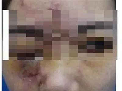 Cô gái trẻ mất thị lực, đau nửa đầu sau tiêm filler làm đầy mũi