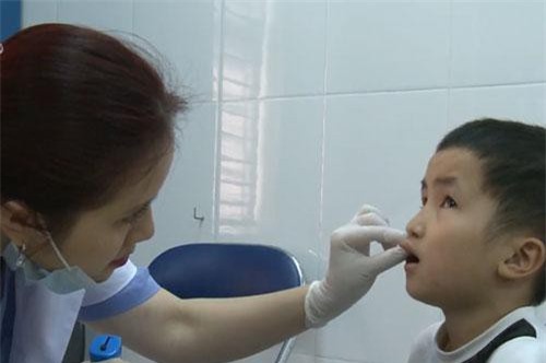 Phẫu thuật miễn phí cho trẻ mắc dị tật khe hở môi, vòm miệng