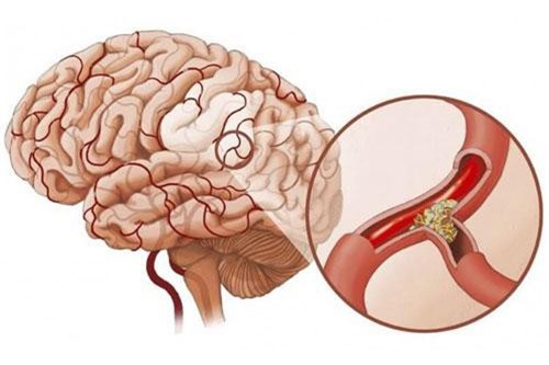 Dấu hiệu nhận biết bệnh tai biến mạch máu não và cách phòng tránh