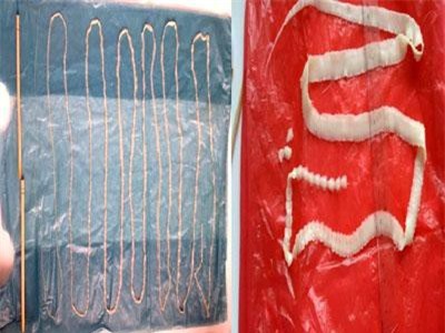 Mắc sán lợn, điều trị như thế nào?