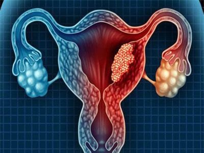 Những vấn đề chị em phụ nữ cần biết về buồng trứng