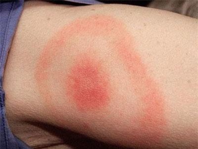 Vết quầng đỏ - dấu hiệu nhận biết của bệnh Lyme