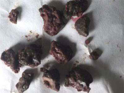 Cẩn trọng bệnh lý xoang do nấm