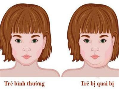 7 dấu hiệu của bệnh quai bị
