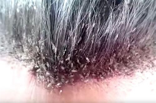 CLIP: "Choáng váng" hàng triệu con chấy lúc nhúc trên đầu 