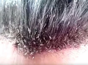 CLIP: "Choáng váng" hàng triệu con chấy lúc nhúc trên đầu