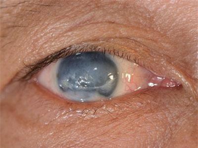 Glôcôm - bệnh khó nhận diện, dễ mù lòa